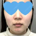 糸リフト / ボトックス（エラ・小顔） アリエル美容クリニック 大宮院 BEFORE サムネイル用
