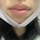 口唇縮小術 / ヒアルロン酸注入（頬） B-LINE CLINIC 池袋院 BEFORE サムネイル用