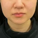 脂肪溶解注射（顔） 湘南美容クリニック 宇都宮院 BEFORE サムネイル用