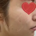 シミ取りレーザー 渋谷美容外科クリニック 新橋院 BEFORE サムネイル用