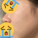 イオン導入 / ピーリング（ハリ・ツヤ） 渋谷美容外科クリニック 横浜院 BEFORE サムネイル用