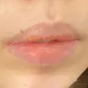 口唇縮小術 YBC横浜美容外科 大宮院 BEFORE サムネイル用