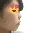 スレッドノーズ / ヒアルロン酸注入（鼻） / ヒアルロン酸注入（あご） / ヒアルロン酸注入（額） キップン整形外科 BEFORE サムネイル用