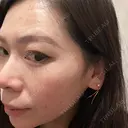 アートメイク（ほくろ） oneUPclinic BEFORE サムネイル用