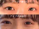 二重埋没 水の森美容クリニック 東京新宿院 BEFORE サムネイル用