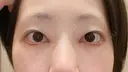 二重埋没 湘南美容クリニック 辻堂アカデミア BEFORE サムネイル用