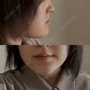 骨切り（あご） / 脂肪吸引（顔） / その他（輪郭） 銀座マイアミ美容外科 BEFORE サムネイル用