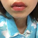 あごプロテーゼ 恵聖会クリニック 京橋院 BEFORE サムネイル用