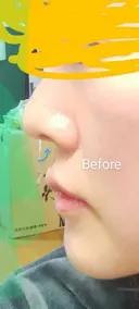 軟骨移植 LIKI CLINIC KOBE BEFORE サムネイル用