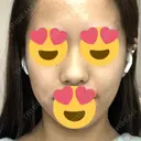 隆鼻術 / 鼻尖形成（切開） / 脂肪吸引（顔） / 軟骨移植 あいちビューティークリニック栄本院 BEFORE サムネイル用