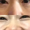 再生医療 / レーザートーニング（美白・肝斑） 品川スキンクリニック立川院 BEFORE サムネイル用