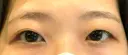 二重切開 / その他（目元） LIKI CLINIC KOBE BEFORE サムネイル用