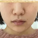 毛穴洗浄（ハイドラフェイシャルなど） 大阪消化器内科・内視鏡クリニック難波院 BEFORE サムネイル用