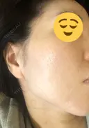 ヴァンパイアフェイシャル 大阪TAクリニック BEFORE サムネイル用