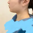バッカルファット除去 / 脂肪吸引（顔） 湘南美容クリニック 新潟院 BEFORE サムネイル用
