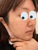 シミ取りレーザー / 光治療（フォトフェイシャルなど） 渋谷美容外科クリニック 新橋院 BEFORE サムネイル用