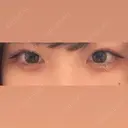 ヒアルロン酸注入（涙袋） 渋谷美容外科クリニック 新宿院 BEFORE サムネイル用