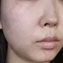 光治療（フォトフェイシャルなど） / ピーリング（ハリ・ツヤ） AURORA CLINIC（オーロラクリニック）新宿院 BEFORE サムネイル用