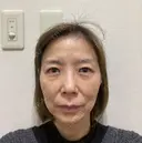 糸リフト / クマ治療 / 下まぶたたるみ取り / 下まぶたの脂肪取り / 眉下切開 / 脂肪注入（額） 銀座みゆき通り美容外科 東京本院 BEFORE サムネイル用