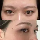 脂肪溶解注射（まぶた） YBC横浜美容外科 大宮院 BEFORE サムネイル用