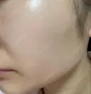 ピーリング（ニキビ・毛穴） 渋谷美容外科クリニック 横浜院 BEFORE サムネイル用