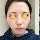 レーザートーニング（美白・肝斑） 渋谷美容外科クリニック 池袋院 BEFORE サムネイル用