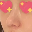 軟骨移植 R.O.clinic BEFORE サムネイル用