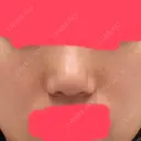 ヒアルロン酸注入（鼻） 東京美容外科 銀座院 BEFORE サムネイル用