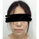 骨切り（あご） / セットバック / 輪郭修正 リラ・クラニオフェイシャル・クリニック 大阪院 BEFORE サムネイル用