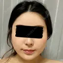 骨切り（あご） / 骨削り（エラ） / 骨削り（頬） リラ・クラニオフェイシャル・クリニック BEFORE サムネイル用