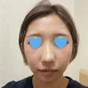 隆鼻術 / 鼻尖形成（切開） / 鼻中隔延長（切開） / 軟骨移植 / 骨切幅寄せ / 真皮移植 Zetith Beauty Clinic 銀座院 BEFORE サムネイル用