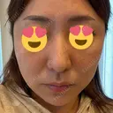 その他（肌） CHRISTINA CLINIC 銀座 BEFORE サムネイル用