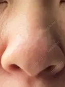 隆鼻術 / 鼻尖形成（切開） / 軟骨移植 白山クリニック 大分 BEFORE サムネイル用