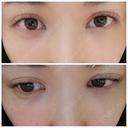 二重埋没 アロマ美容外科クリニック BEFORE サムネイル用