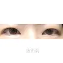 二重埋没 湘南美容クリニック 福島院 BEFORE サムネイル用