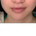 骨切り（あご） 銀座マイアミ美容外科 BEFORE サムネイル用