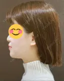 骨切り（あご） / 骨削り（エラ） / その他（輪郭） / セットバック アーククリニック BEFORE サムネイル用