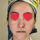 隆鼻術 / 鼻尖形成（切開） / 軟骨移植 湘南美容クリニック 辻堂アカデミア BEFORE サムネイル用