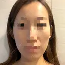 骨切り（あご） 銀座マイアミ美容外科 BEFORE サムネイル用