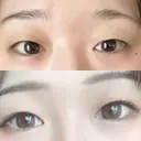 二重埋没 水の森美容クリニック 大阪梅田院 BEFORE サムネイル用