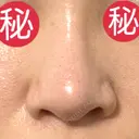 小鼻縮小（切開） 恵聖会クリニック 京橋院 BEFORE サムネイル用