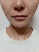 小鼻縮小（切開） / 人中短縮 / 口角挙上 / その他（口元） オザキクリニック LUXE新宿 BEFORE サムネイル用