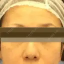 鼻尖縮小 リッツ美容外科 大阪院 BEFORE サムネイル用