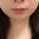 ヒアルロン酸注入（唇） フィラークリニック 名古屋栄院 BEFORE サムネイル用