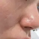 エレクトロポレーション / 毛穴洗浄（ハイドラフェイシャルなど） Fellez Clinic【フェルズクリニック】 BEFORE サムネイル用