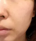 ピーリング（ニキビ・毛穴） / エレクトロポレーション / 光治療（フォトフェイシャルなど） AURORA CLINIC（オーロラクリニック）新宿院 BEFORE サムネイル用