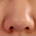 軟骨移植 フェアクリニック川口 BEFORE サムネイル用