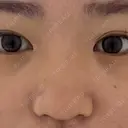 二重埋没 / その他（鼻） / 上まぶたの脂肪取り / ボトックス（エラ・小顔） TCB東京中央美容外科 岡山院 BEFORE サムネイル用