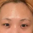 目頭切開 / 隆鼻術 / 鼻尖形成（切開） / 軟骨移植 湘南美容クリニック 金山院 BEFORE サムネイル用