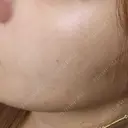 ピコレーザートーニング（美白・肝斑） / フラクショナルレーザー（毛穴・ニキビ跡） ルラ美容クリニック 渋谷本院 BEFORE サムネイル用